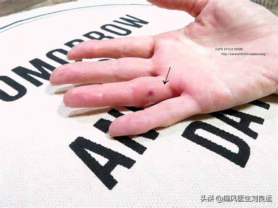 蜂针疗法可以治疗痛风吗,蜂疗灸可以治疗痛风吗