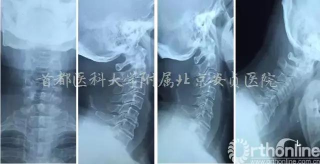 颈椎病引起的胸闷胸痛在哪个部位,颈椎病会引起咳嗽胸闷胸痛吗