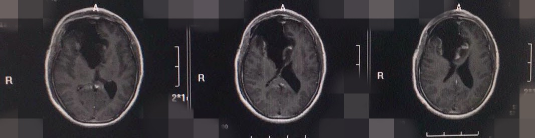 头疼脑ct检查发现脑肿瘤很准确,头痛十年查出来脑瘤