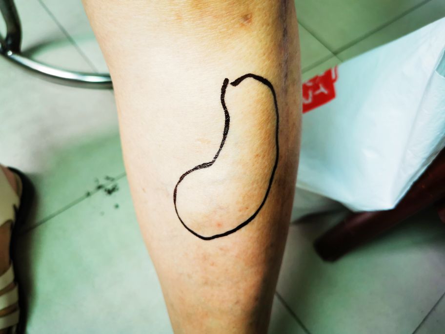 脂肪肉瘤和脂肪瘤怎么分辨,脂肪瘤很常见吗