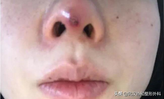 线雕隆鼻的副作用和危害,线雕隆鼻费用一般多少钱