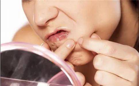 挤痘痘后怎么预防颅内感染,女孩挤痘引发颅内感染新闻