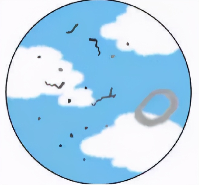 眼前时不时有小黑影,眼前有小黑点怎么治疗