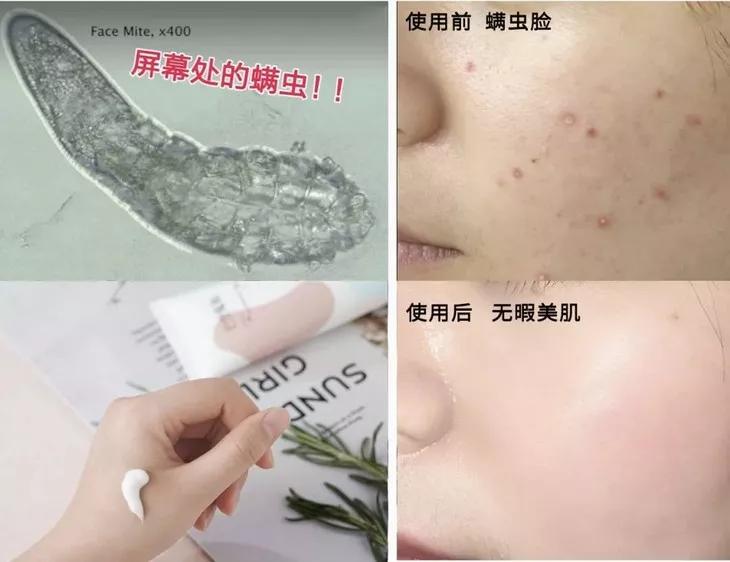 专治螨虫的洗面奶,螨虫专用洁面乳