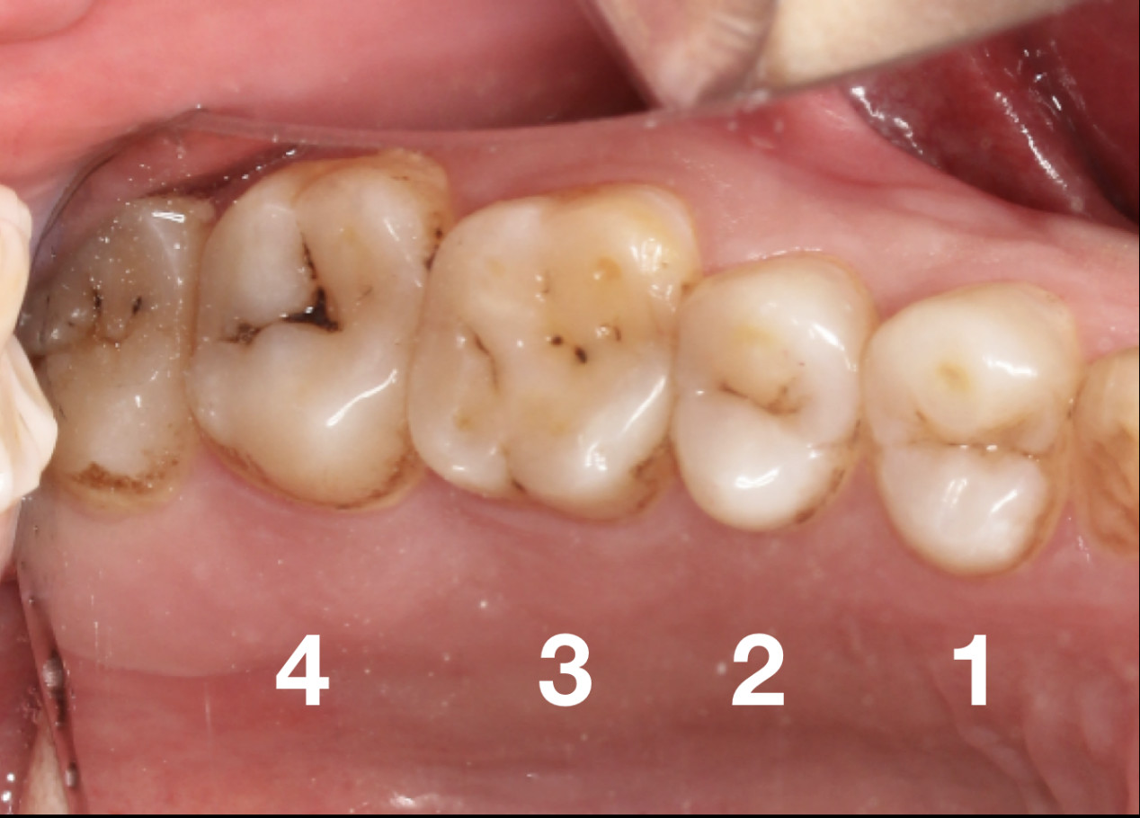 牙齿长黑线？你的牙危险了！教你怎么补救