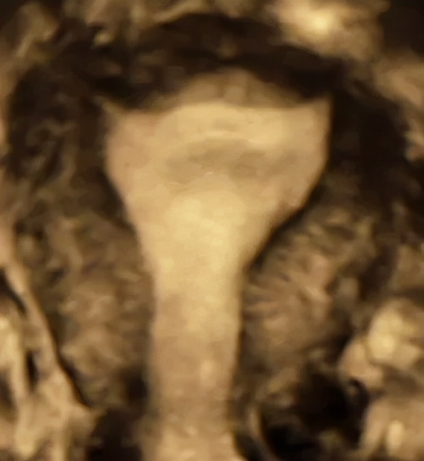 四维超声能看出宫腔粘连吗,做超声能看出来宫腔粘连吗