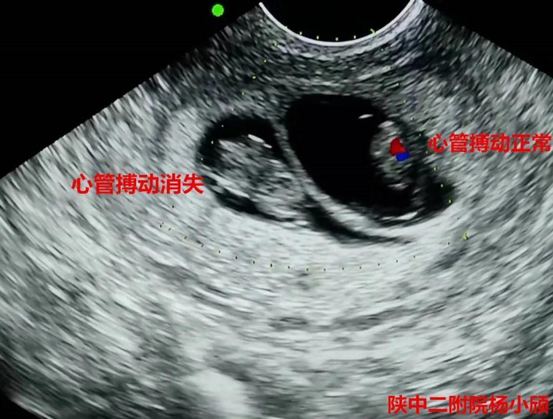 陕西中医药大学第二附属医院生殖内分泌科完成一例高难度减胎术
