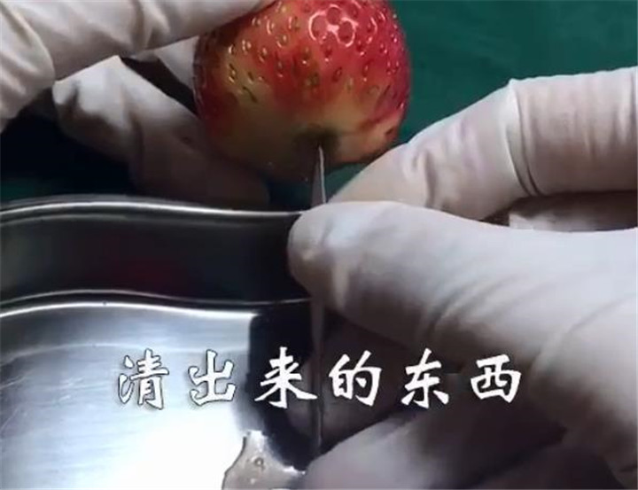 人流的危害科普,人流是不是越年轻伤害越大