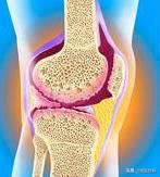 膝盖后面有个鼓鼓的包是不是病,膝盖后面有个包怎么回事