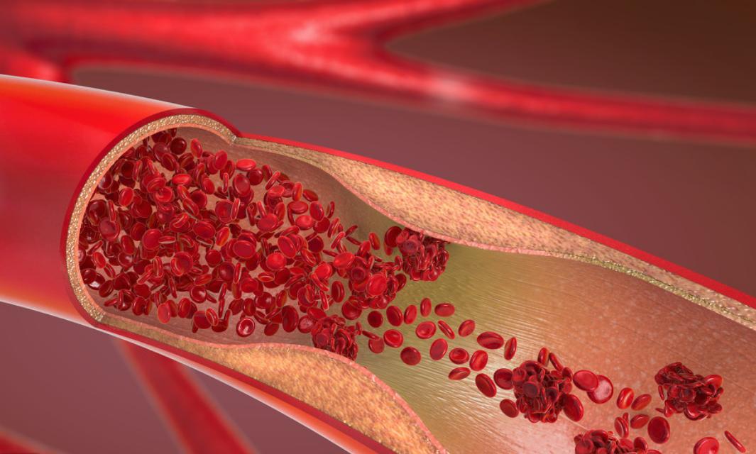 冠状动脉狭窄到什么程度需要支架,冠状动脉狭窄什么程度需要放支架