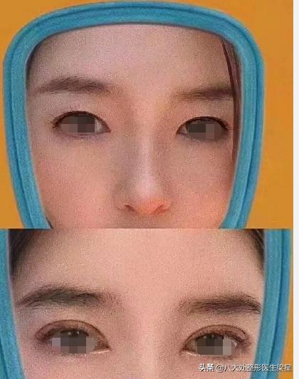 双眼皮手术开眼角恢复过程,双眼皮全切开眼角恢复期图