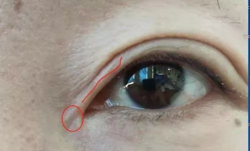 女子整容后惨不忍睹,女子双眼皮整容失败