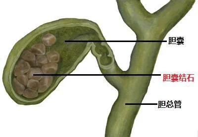 胆红素偏高会影响凝血么,胆红素偏高会引起肝掌吗
