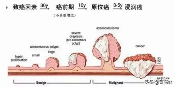 大肠息肉—藏在肚子里的定时*弹炸**，只要发现，必须格杀勿论！