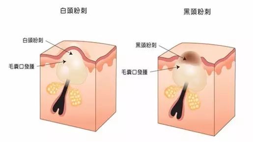 鼻子闭口黑头去除小妙招,鼻子黑头小方法轻松解决