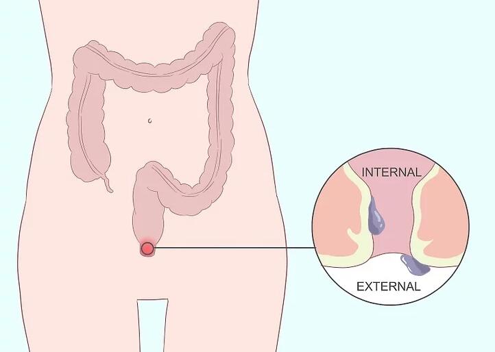 如果有轻微痔疮要怎么改善,得了痔疮不要怕食疗简单又方便