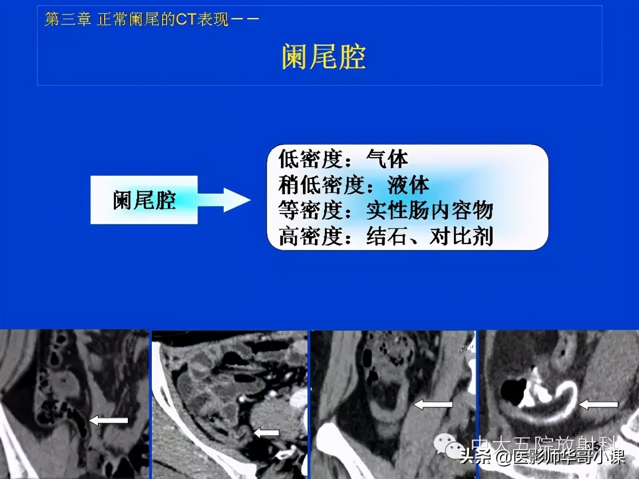 阑尾炎课件,阑尾炎的超声课件