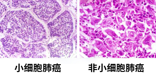肺癌要怎么分辨早晚期,肺癌早期和晚期怎么判断