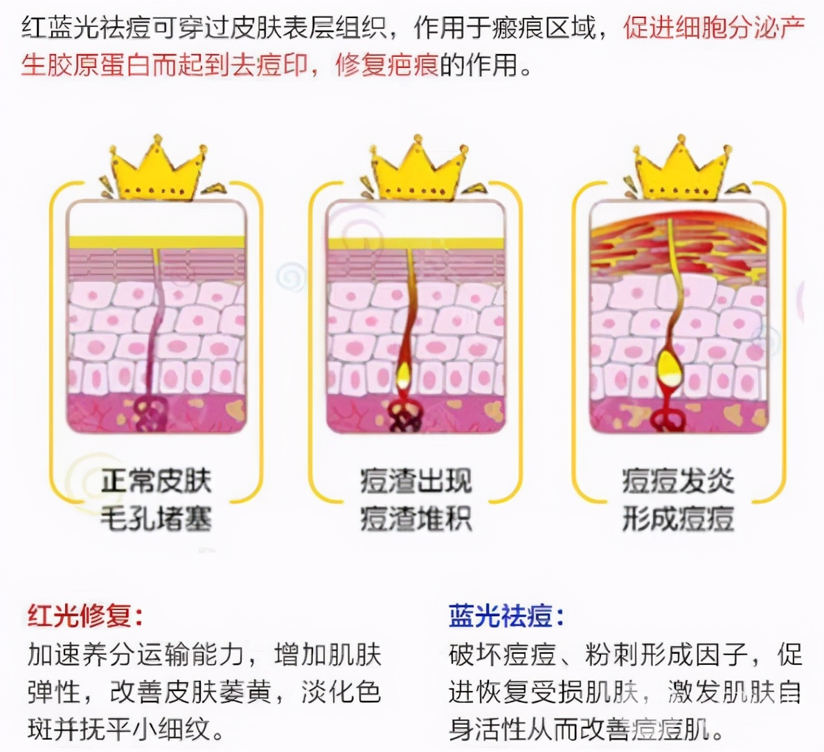 祛痘一般用什么医美,痘肌可以做祛痘医美项目