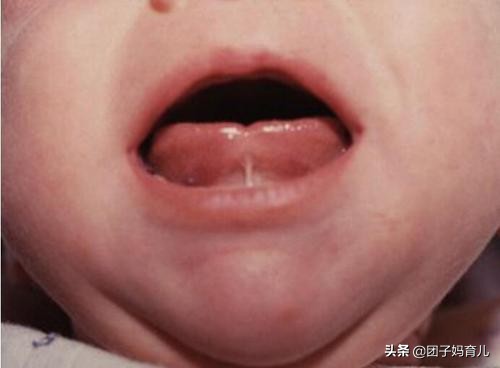 孩子不讲话什么情况下要剪舌根,1岁多孩子剪舌根