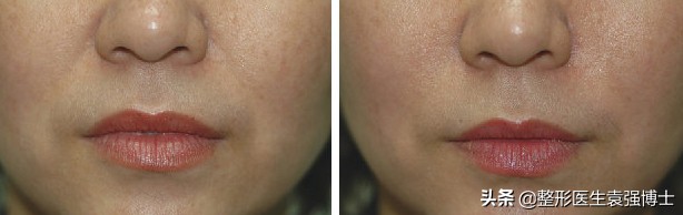 去掉法令纹最好的方法的视频,不用任何化妆品去掉眼部法令纹