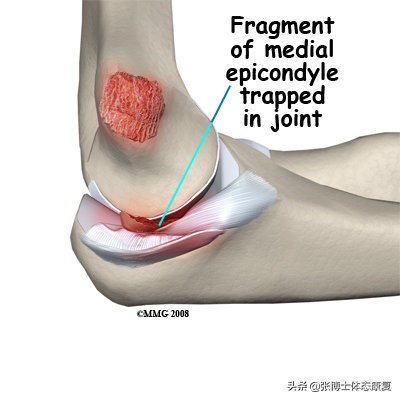 运动肘关节常见创伤及治疗方法,怎么预防肘关节康复二次损伤