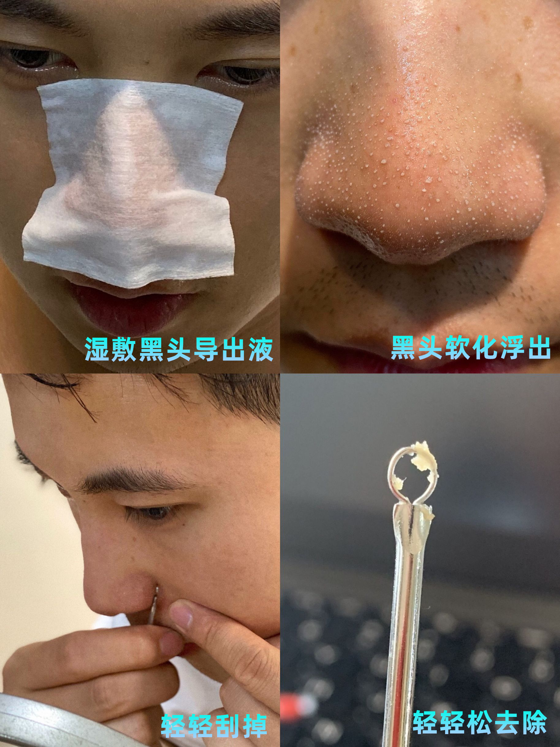 黑头如果不管的话会怎样,如果不清理黑头会怎样