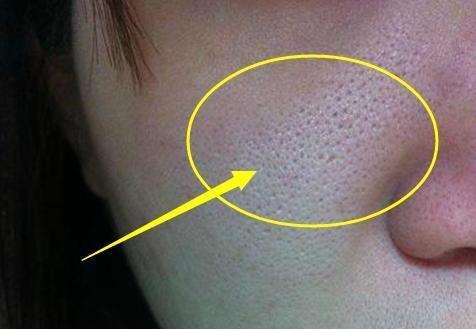 毛孔粗大有黑头适合什么粉底液,遮盖粗大毛孔黑头用什么粉底液