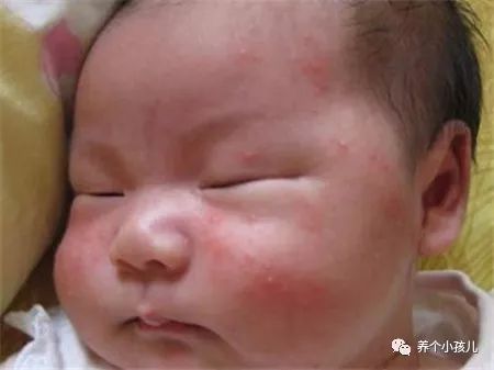 宝宝出现湿疹的原因和护理措施,高烧湿疹的症状及治疗方法