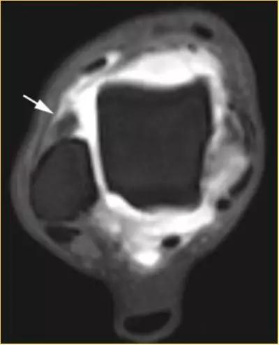 踝关节撞击症问诊,踝关节内侧撞击综合症位置图