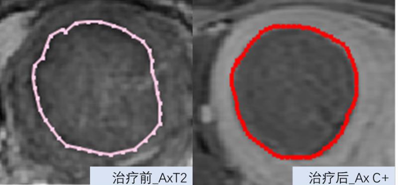 震颤磁波刀帕金森,磁波刀震颤全国哪家医院有