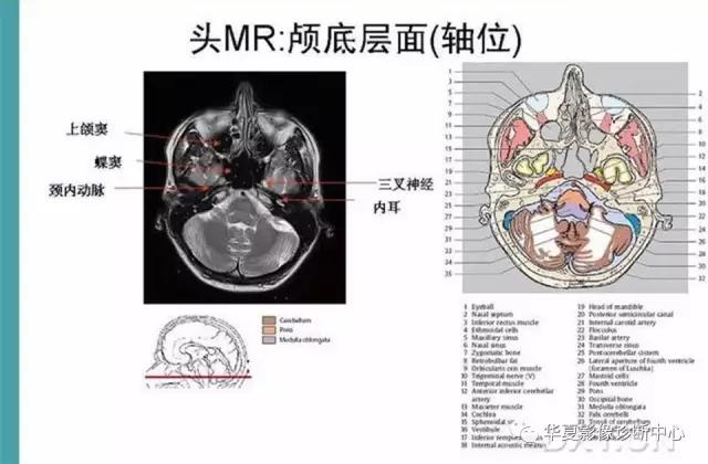 电子版头颅ct与mri断层解剖,头颅mri血管解剖与分段详解