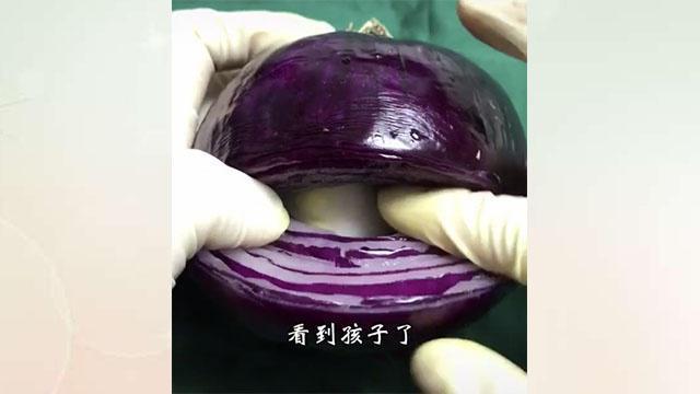 产科医生剖腹产真实流程,妇产科医生剖腹产片段