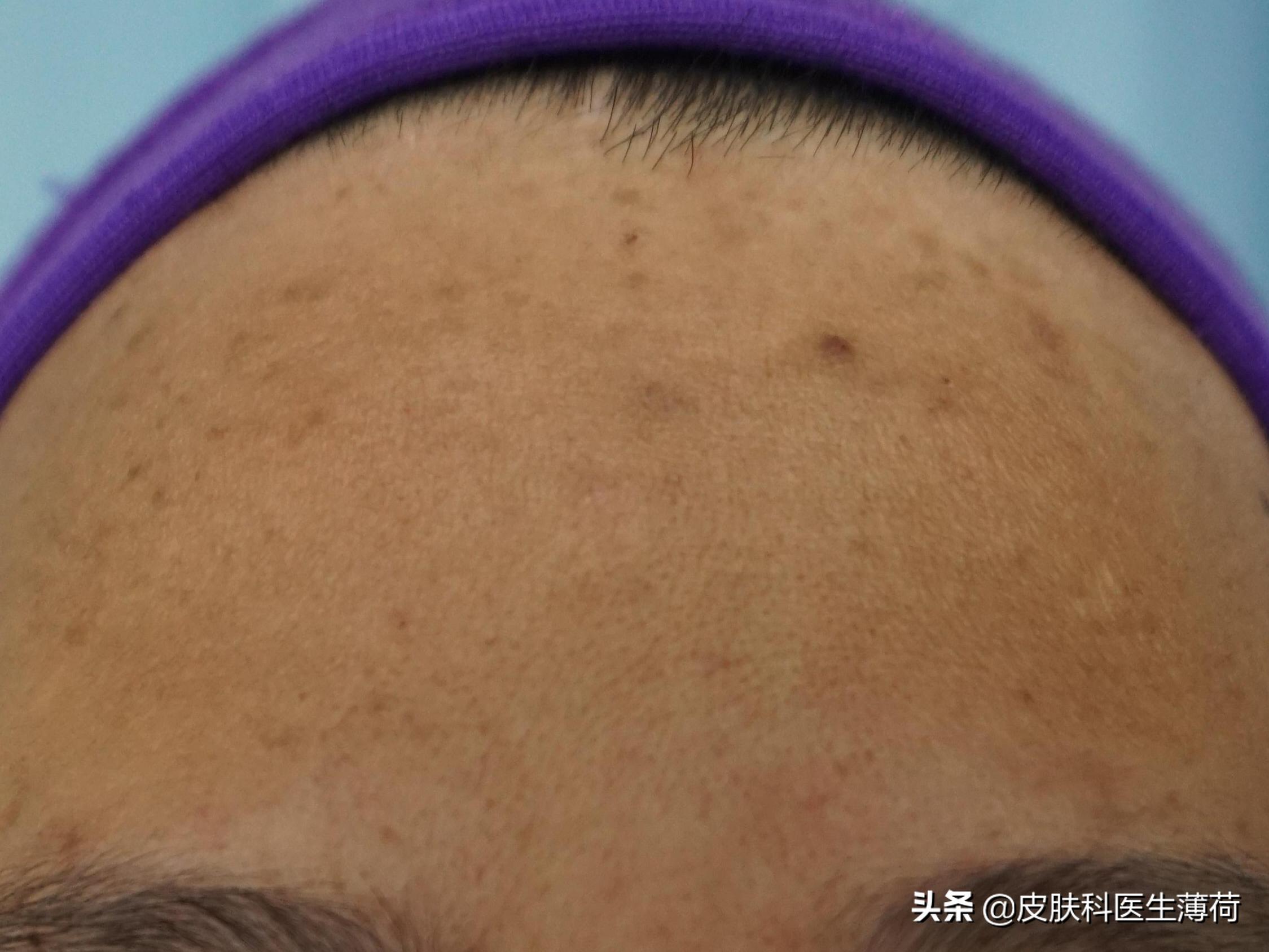 皮肤科医生教你祛痘印,医院的皮肤科主治痘痘痘印吗