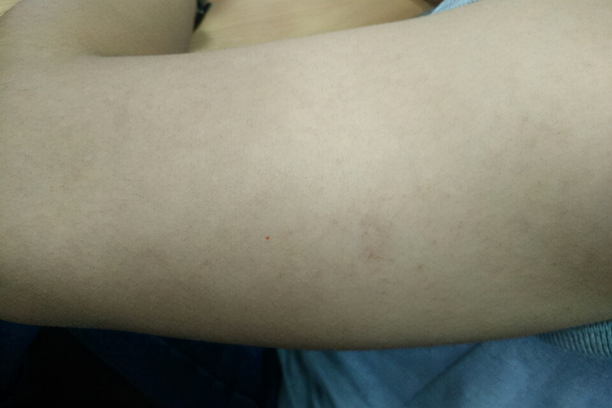 天气冷了为什么皮屑多了,天气干燥起癣的原因