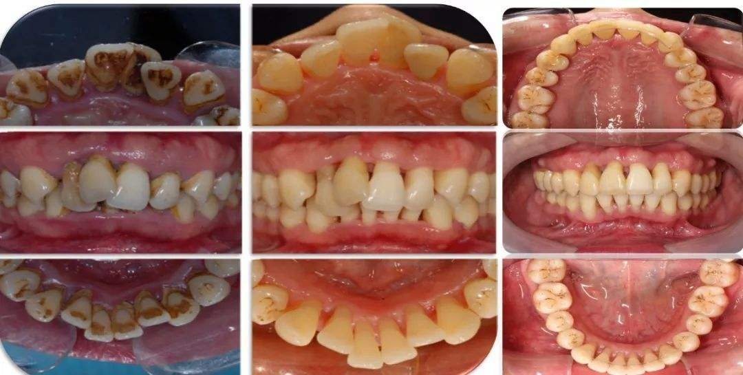 牙龈萎缩是怎么回事如何预防,预防牙龈萎缩吃什么维生素