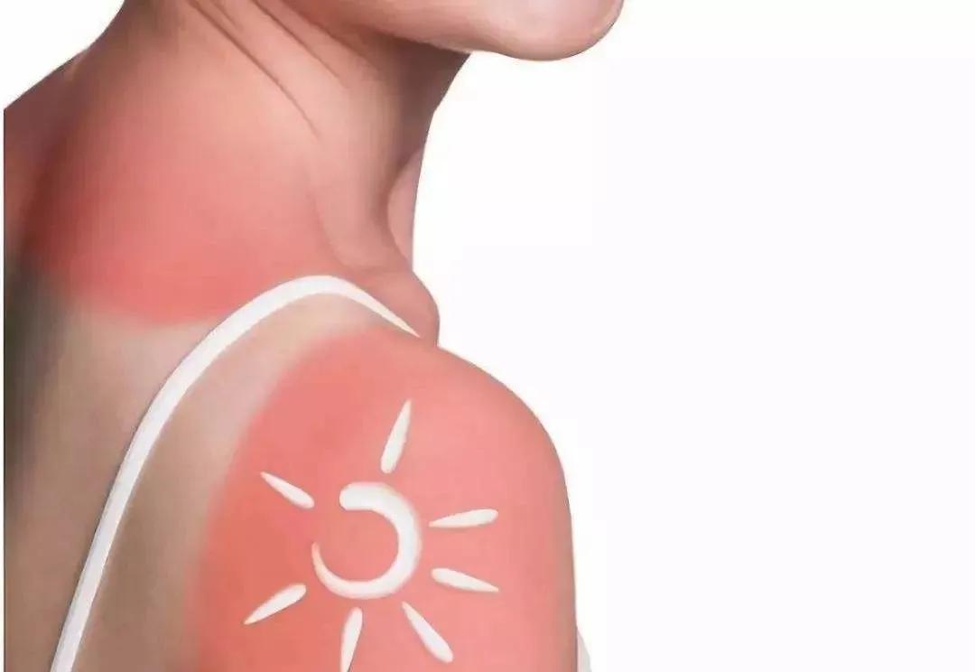 宝宝三岁前晒伤,别等孩子晒黑晒伤才开始涂防晒