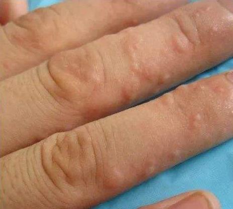 手上长泡如何根治,手上一个小水泡反复发作怎么回事