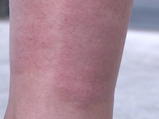 激光脱毛99元6次是真的吗,激光脱毛有疤痕吗