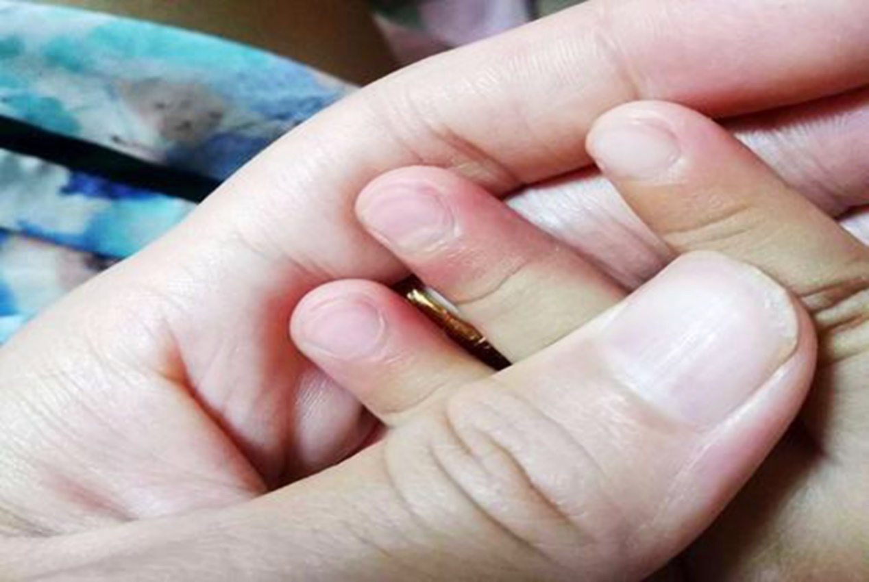 小孩指甲短秃是怎么回事,孩子指甲很秃不长怎么办