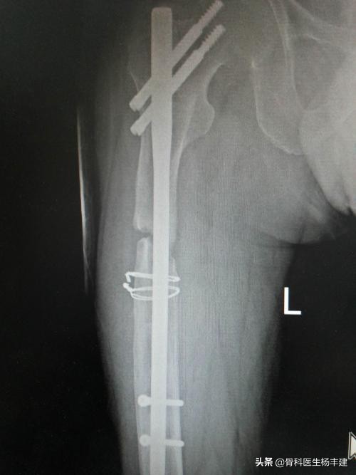 锁骨骨折后钢板断裂怎么办,股骨骨折钢板断裂原因分析
