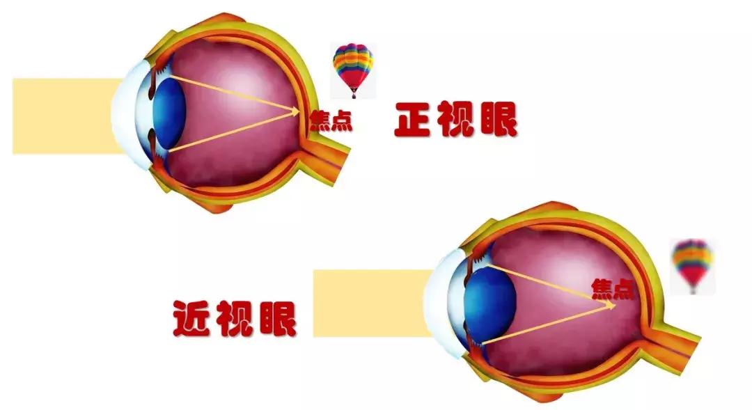 近视手术无法治愈近视,小孩近视能治愈吗