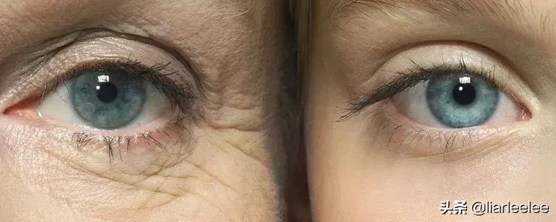 眼角皱纹最显老要注意防晒,眼角皱纹去皱最有效的方法