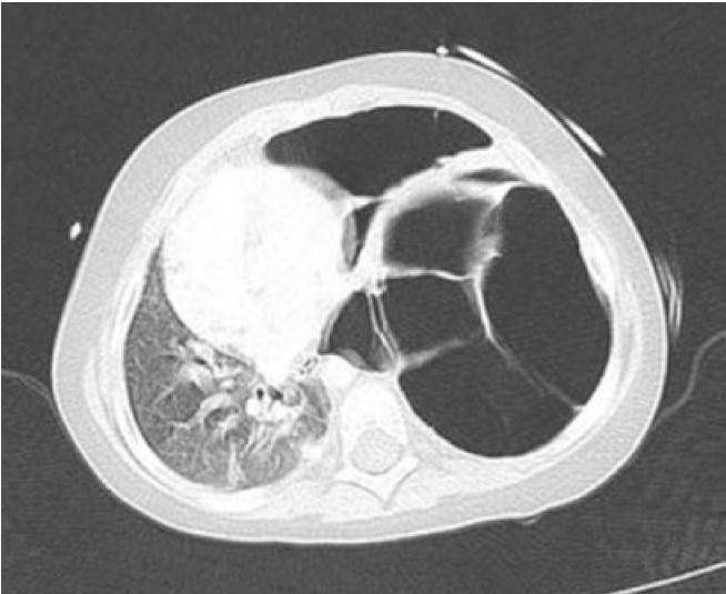一种罕见病常跟儿童湿疹混淆，它是什么病呢？