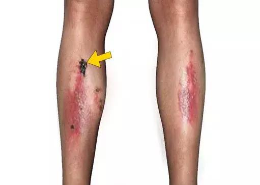 糖友易出现又纠结的8种皮肤病变，医生来支招