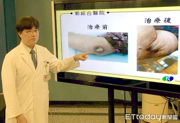 夭寿!伤口好不了又一直流脓 原来是它在作祟