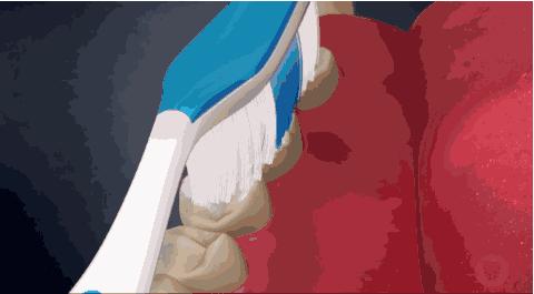 改变刷牙方式楔状缺损就会停止吗,刷牙导致楔状缺损牙齿会断么