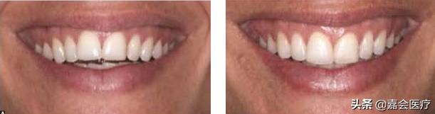 怎么不露齿笑才自然好看,如何笑不露齿笑起来好看的技巧