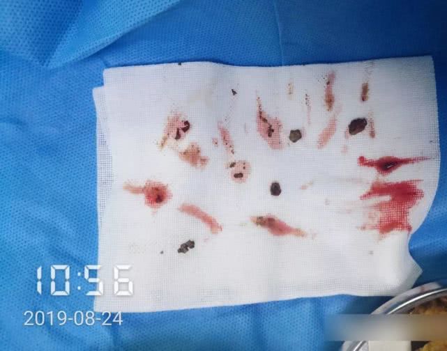 阑尾炎形成窦道的原因,阑尾炎一孔微创手术全过程