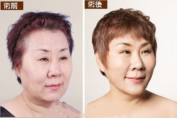 局部拉皮除皱整形,拉皮除皱整形去哪家医院